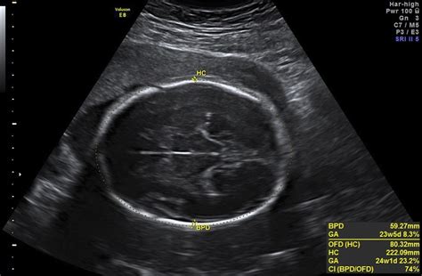 The Normal Fetal Cephalic Index in the Second and Third Trim... : Ultrasound Quarterly