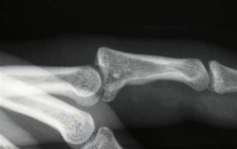 15 best images about trimalleolar fracture on Pinterest | Calf ...