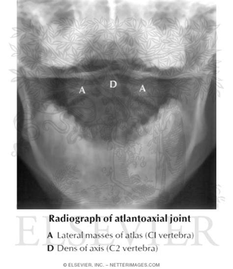 Radiograph of Atlantoaxial Joint