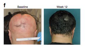 Are JAK inhibitors the future for management of Alopecia Areata? - Dr Paul Farrant