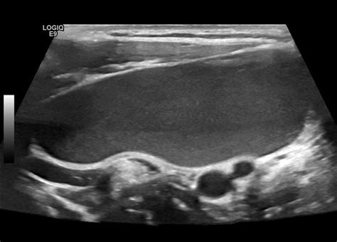 Branchial Cleft Cyst Ultrasound