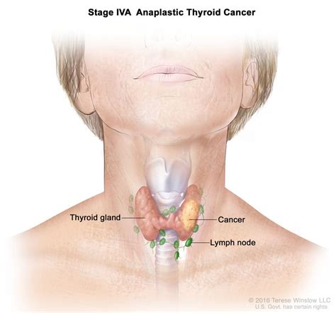 Thyroid Cancer Treatment (PDQ®)–Patient Version - NCI