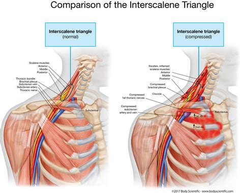 Thoracic Outlet Syndrome, Rib Resection, Recovery Stories?