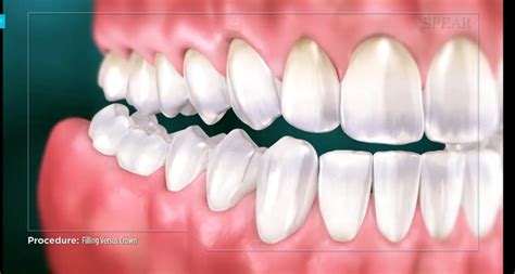 What Is the Difference Between a Crown and A Filling? - Visalia Dentist