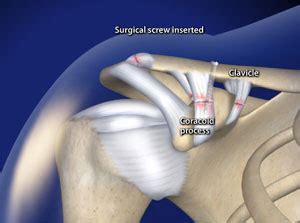 Arthroscopic Acromioclavicular (AC) Joint Separation Repair in Plano, Frisco, McKinney and Allen