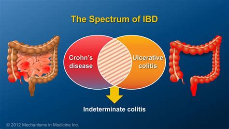 As more is learned about the genetics of Crohn’s disease and UC, it is becoming evident that ...