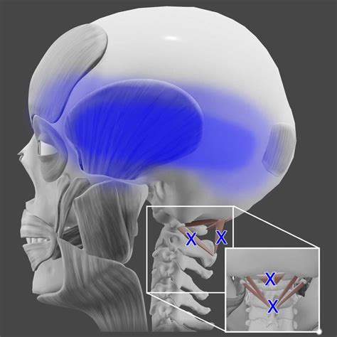 Acupuncture for Suboccipital Muscles — Morningside Acupuncture NYC