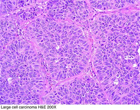 Pathology Outlines - Large cell