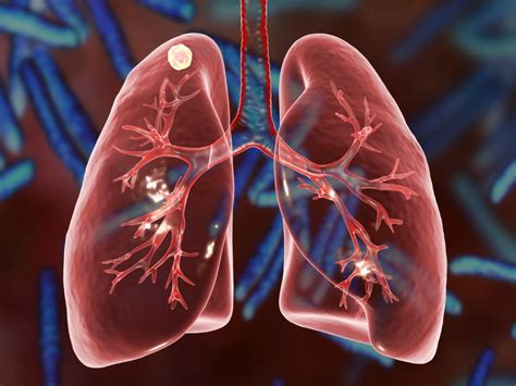 Bronchial Infection Is Associated with More Rapid Lung Function Decline in COPD