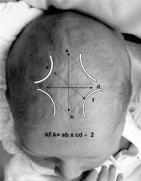 Figure 1 from Evolution of Anterior Fontanel Size in Normal Infants in the First Year of Life ...