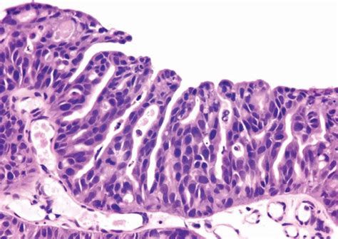 Histologic Variants of Urothelial Carcinoma | Abdominal Key