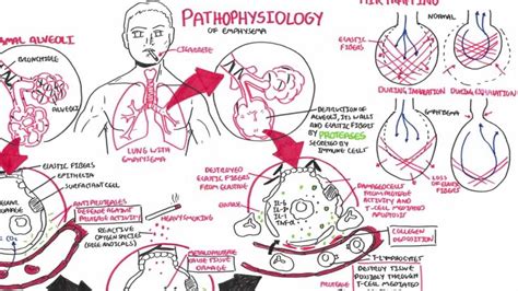 Pathophysiology Concept Map Emphysema Pathophysiology Nursing | Images ...