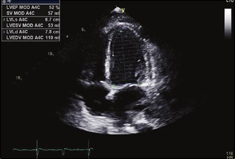 Echocardiography Ejection Fraction