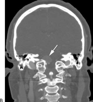 Jugular Foramen Mri