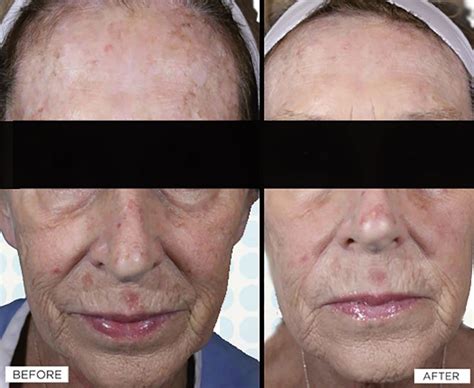 Laser Skin Resurfacing Treatment Guide: Cost, Side Effects, and More | Allure