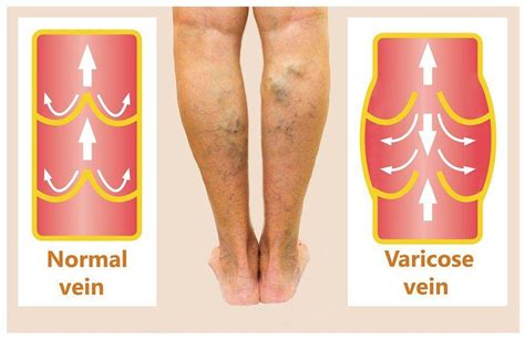 Varicose Veins Treatment - Complete Guide To Varicose Veins