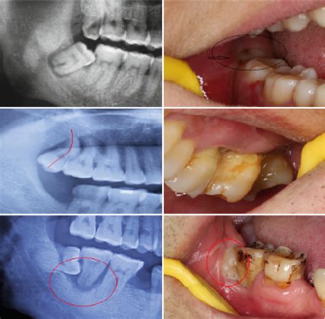 Wisdom Teeth Function – Boston Dentist – Congress Dental Group 160 Federal St Floor 1, Boston ...