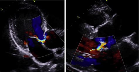 Transthoracic Echocardiogram | Download Scientific Diagram