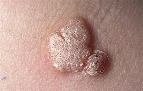 Adult Skin Problems Slideshow: Pictures of Rashes, Eczema, Hives, and More | HEALTH | Pinterest ...