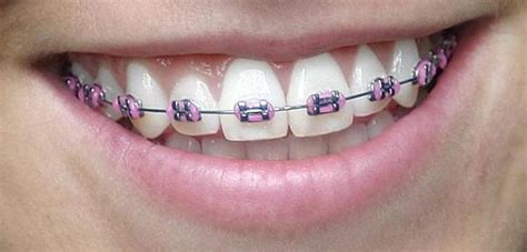 Braces: Pink, Purple, Black, Blue! What colors look best? - Headgear Braces