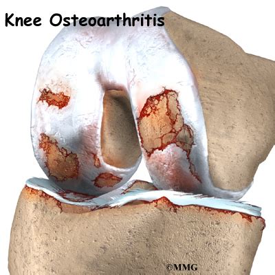 Knee Osteoarthritis | eOrthopod.com