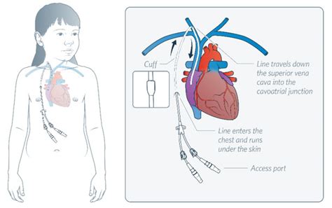 Central Venous Catheter Purpose