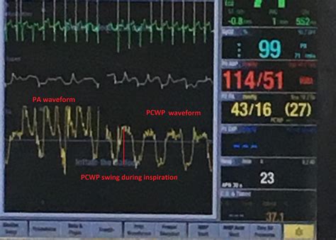 Utilizing CVP waveforms to assess the intensity of inspiratory efforts ...