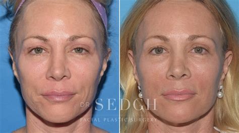 Laser Skin Treatments Before and After Photos | Dr. Sedgh