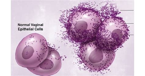 Bacterial Vaginosis - www.medicoapps.org