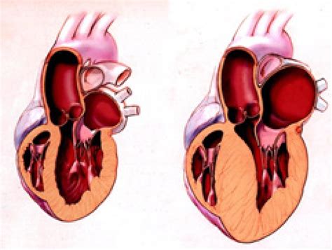 Cardiomiopatia Hipertrófica – Revisão - ABC Cardiol