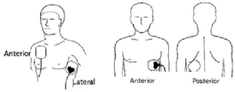 Anteroposterior Aed Placement