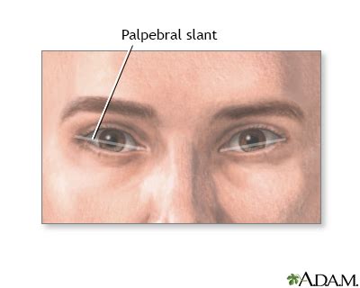 Palpebral slant - eye Information | Mount Sinai - New York