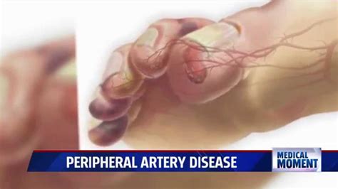 Symptoms and Treatments for Peripheral Artery Disease (PAD) - YouTube