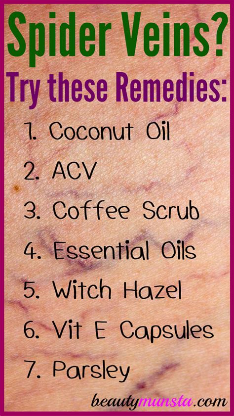 7 Natural Remedies for Spider Veins - beautymunsta - free natural beauty hacks and more!