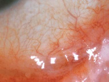 Ocular Cicatricial Pemphigoid (OCP): Background, Pathophysiology, Epidemiology