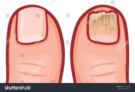 Fungal Infection Nails Vector Illustration Stock Vector (Royalty Free ...