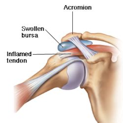 Shoulder Tendinitis Causes & Treatment | Cleveland Clinic: Health Library