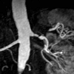 Renal artery stenosis MRI - wikidoc