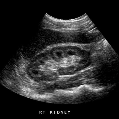 Medullary Sponge Kidney Ultrasound Vascular Ultrasound, Ultrasound Sonography, Chronic Kidney ...