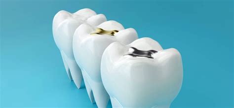 Amalgam Filling Removal | Danville, CA | Pro Smile Dental Care