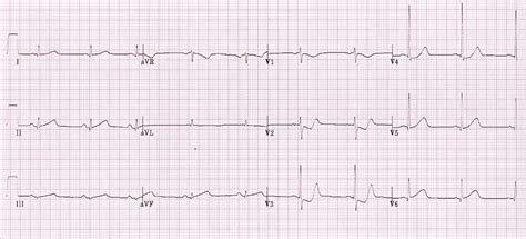 Posterior Myocardial Infarction • LITFL • ECG Library Diagnosis