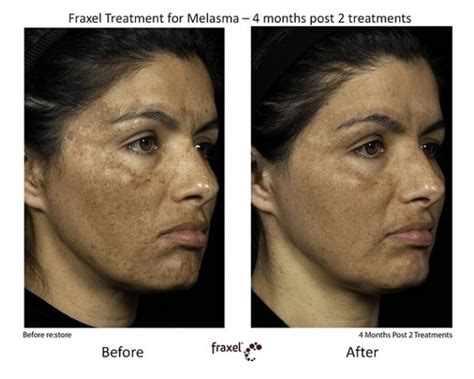 Age Spots Removal - Laser Skin Treatment Clinic Melbourne