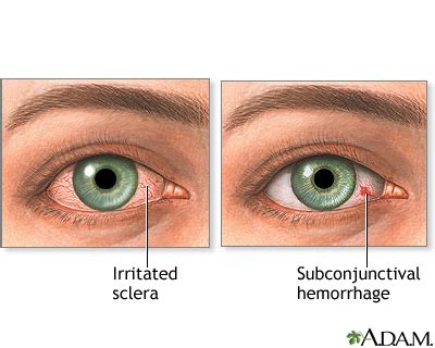 Eye redness: MedlinePlus Medical Encyclopedia