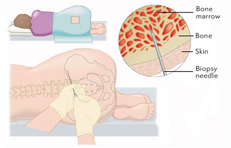 Bone Biopsy Recovery Time - mapageprek