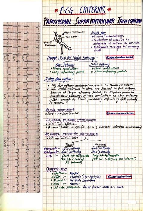 PSVT ECG Criteria - Dr.Shashank Kumar Srivastav