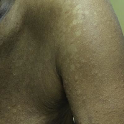 Leukemia Cutis in Acute Myeloid Leukemia Signifies a Poor Prognosis | MDedge Dermatology