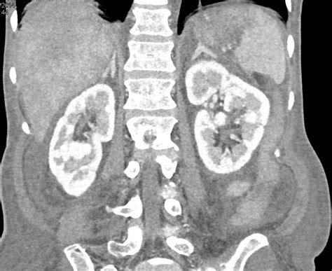 Budd Chiari Syndrome - Liver Case Studies - CTisus CT Scanning