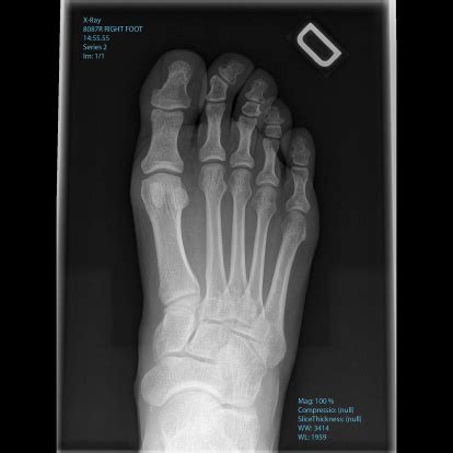 Xray Mans Right Foot Top View Stock Photo - Download Image Now - iStock