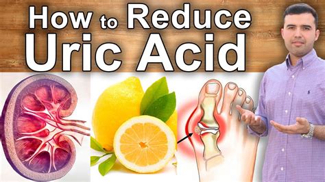 Casual Info About How To Reduce Uric Acid Levels In Blood - Stopsalt