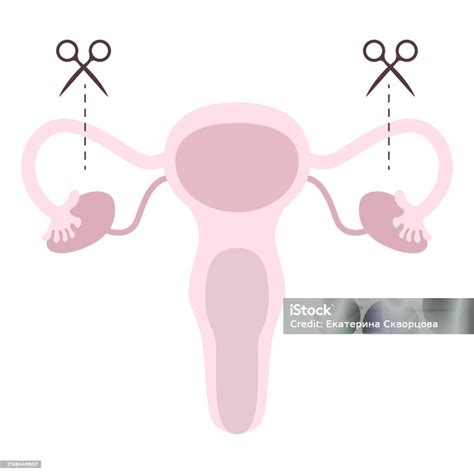 Tubectomy Reversal Tubal Ligation Or Surgical Procedure Tubectomy In Operative Gynecology ...